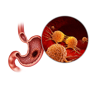 GI Cancers